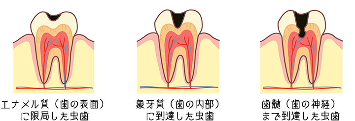 虫歯の進行