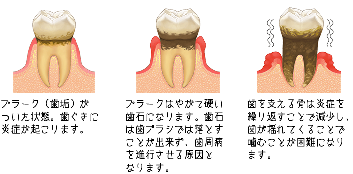 虫歯の進行